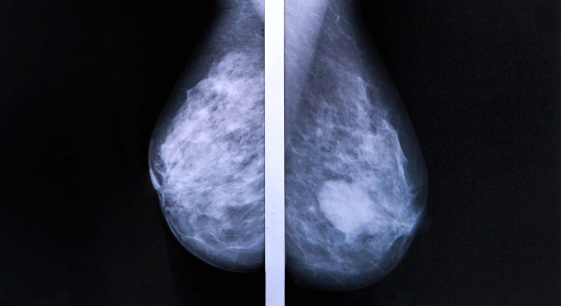 breast scan