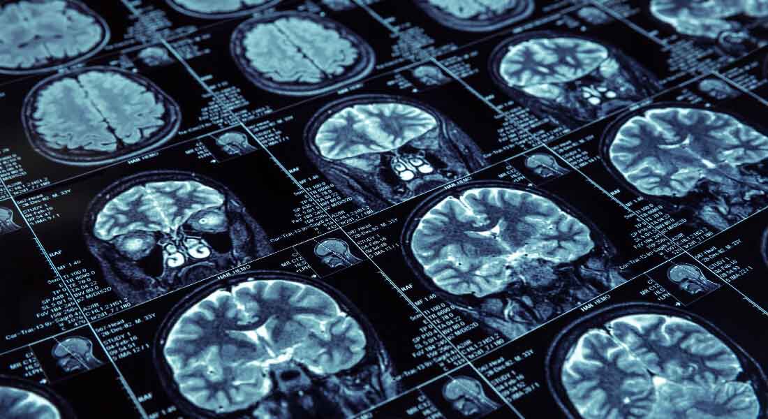 X-ray photos of human brains. 