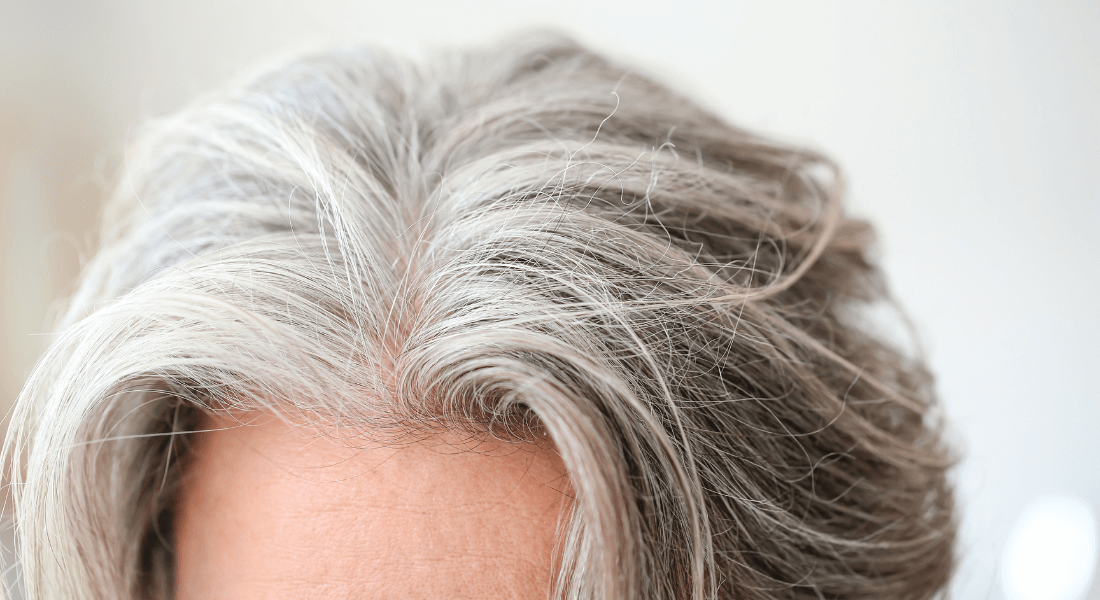 Grey hair at an early age led researchers to new treatment for rare cancer  – University of Copenhagen