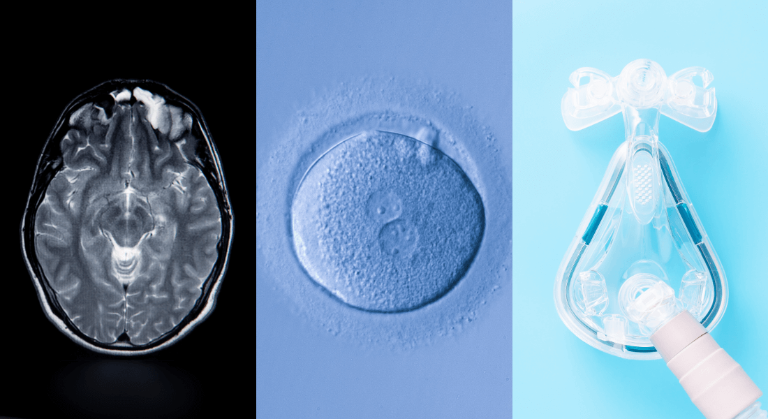 Illustration with three images of a brain scan, egg cells and a C-PAP machine